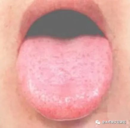 Tongue Diagnosis in Traditional Chinese Medicine: Tongue Coating
