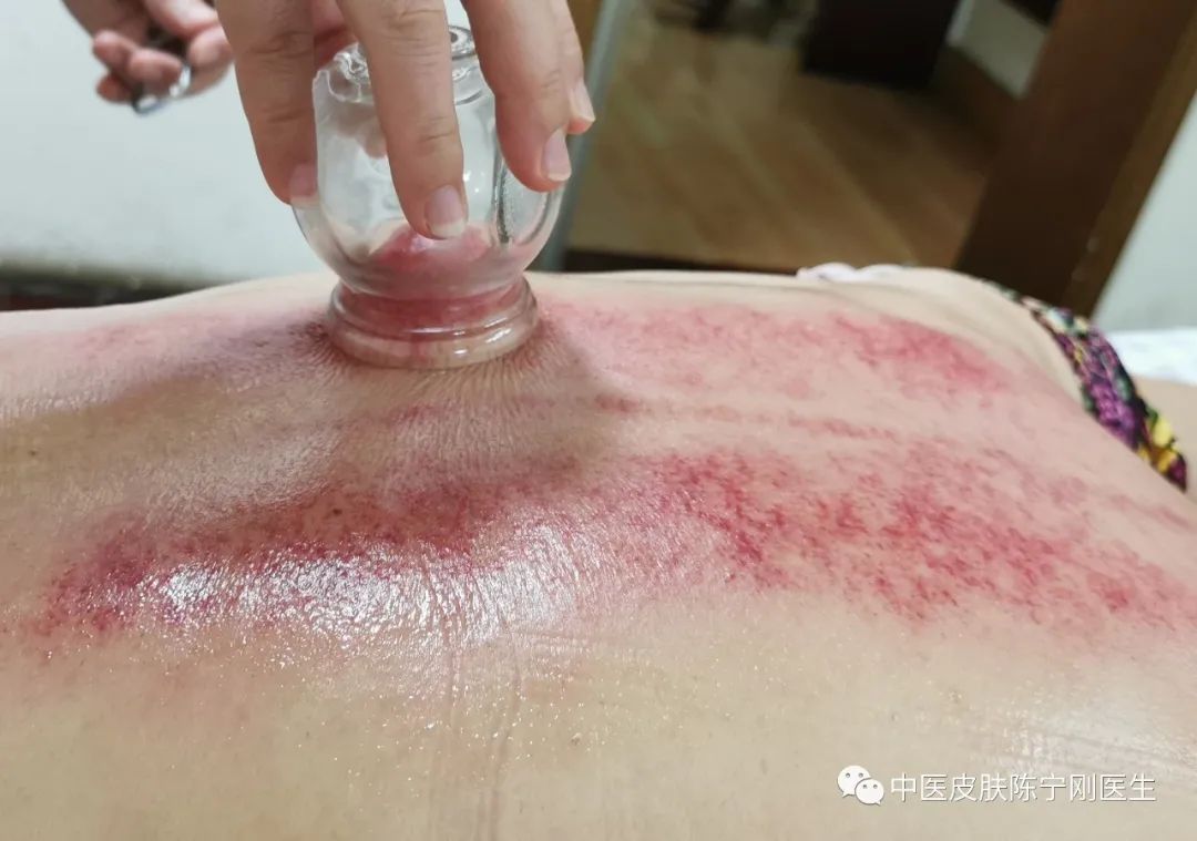 Cupping Therapy: A Traditional Method for Moisture Removal