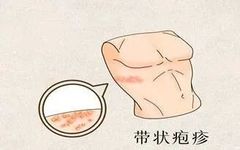 Traditional Chinese Medicine 'Fire Needle' Treatment for Herpes Zoster