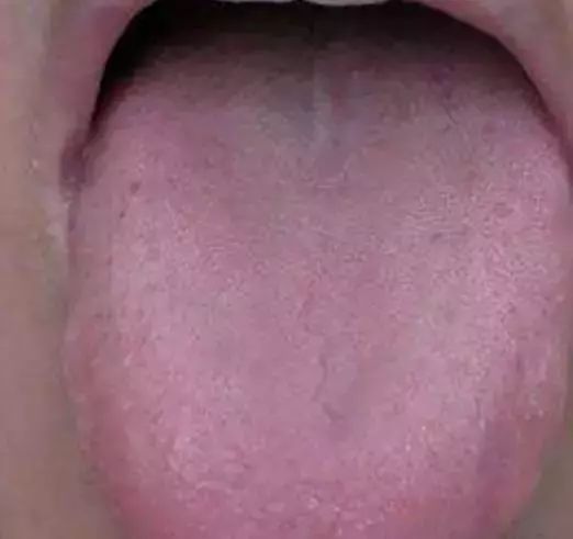 The Most Comprehensive Guide to Tongue Diagnosis! Master It and Become a Tongue Diagnosis Expert