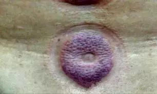 Cupping Therapy on the Back: More Effective than Medication!