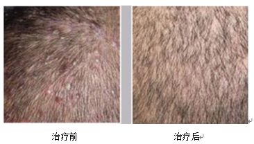 Fire Needle Therapy for Skin Diseases: Visible Safety and Efficacy