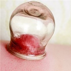 Understanding Cupping Therapy: Common Misconceptions and Precautions