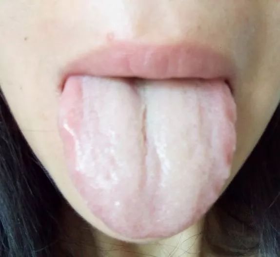 Understanding the State of Organs and Qi-Blood Dynamics Through Tongue Diagnosis