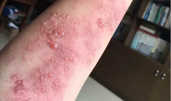 Is Your Condition Worsening After Moxibustion? Congratulations, You're One Step Closer to Recovery!
