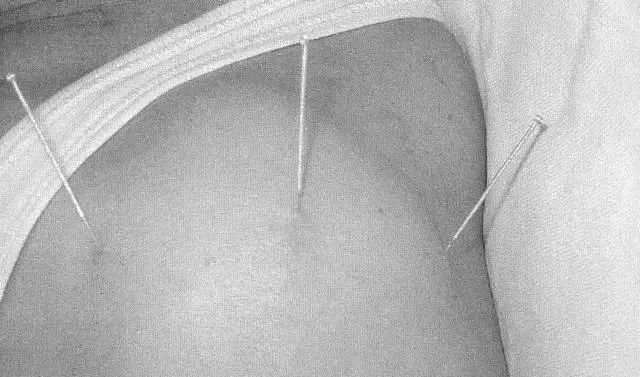 Three Hand Acupuncture Points, Three Foot Acupuncture Points, and Three Shoulder Acupuncture Points!