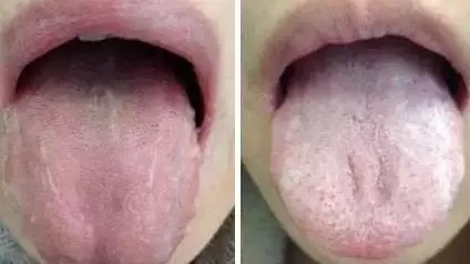 What Does Traditional Chinese Medicine Observe in the Tongue? Nine Body Types and Valuable Tongue Diagnosis Charts!