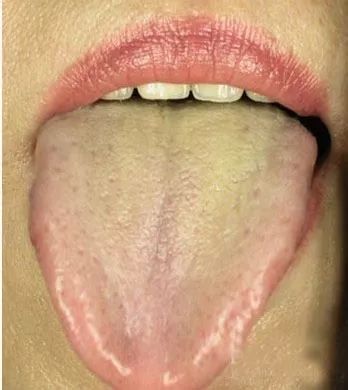 Five Types of Tongue Coating Symptoms and Corresponding Treatment Plans