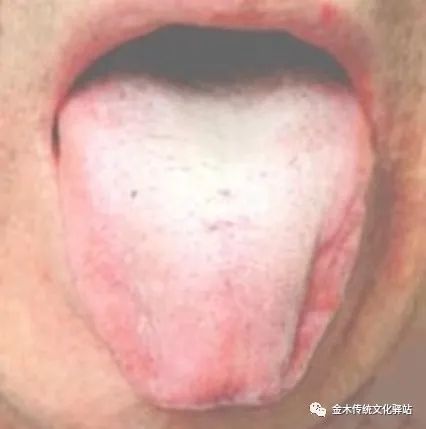 Tongue Diagnosis in Traditional Chinese Medicine: Tongue Coating