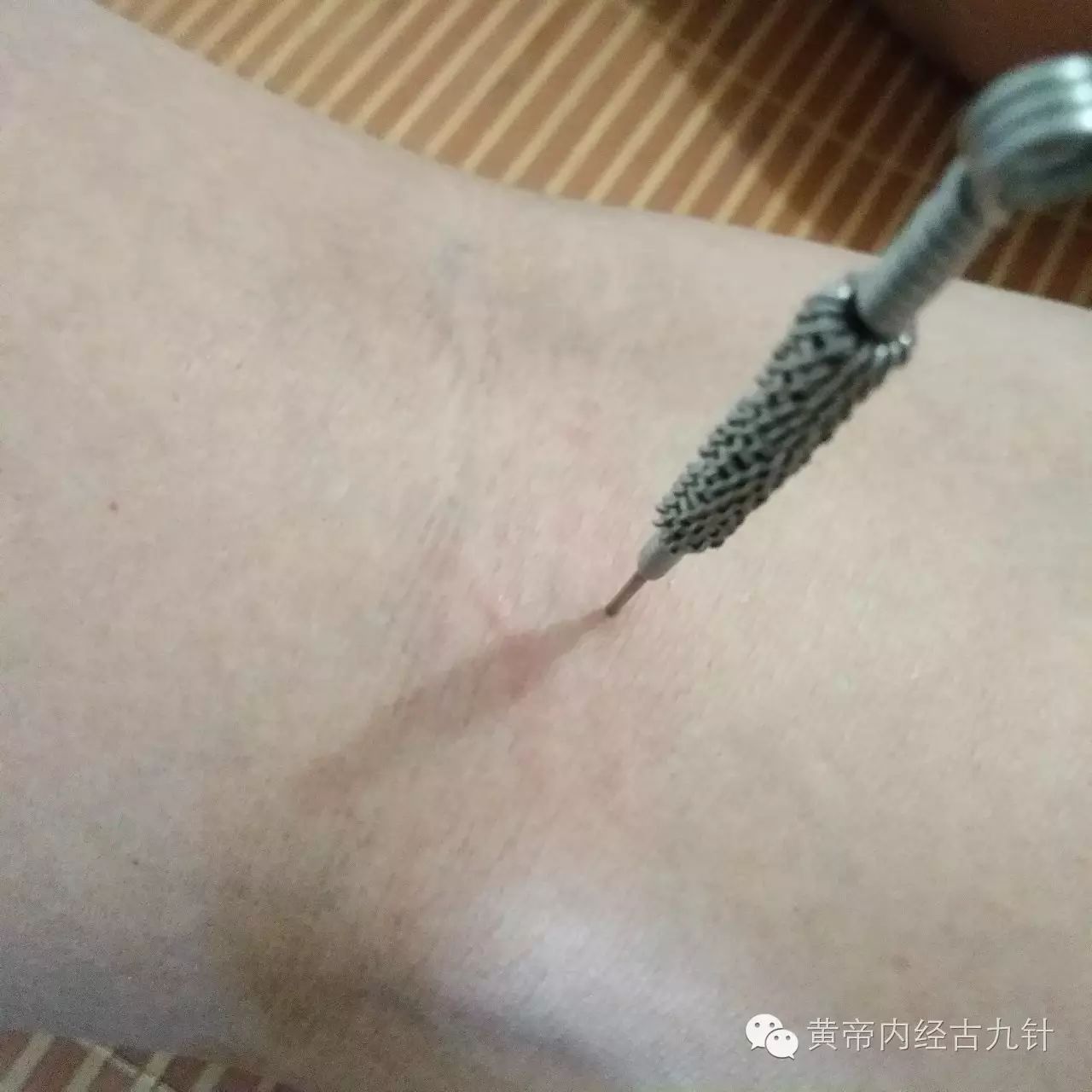 Discussion on the 'Mao Zhen' (Fine Needle) Technique