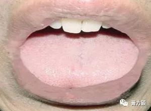 The Health Code Hidden on Your Tongue