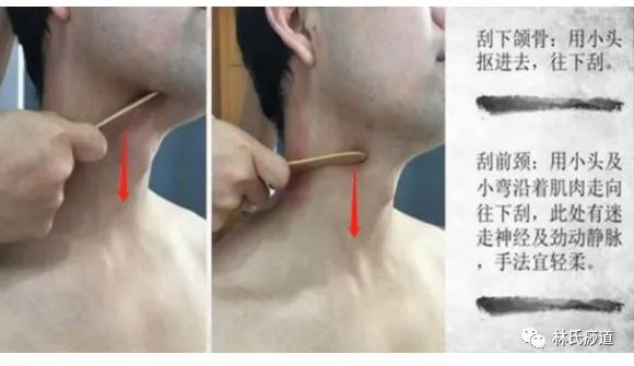 Key Points of Gua Sha