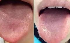 What Does Traditional Chinese Medicine Observe in the Tongue? Nine Body Types and Valuable Tongue Diagnosis Charts!
