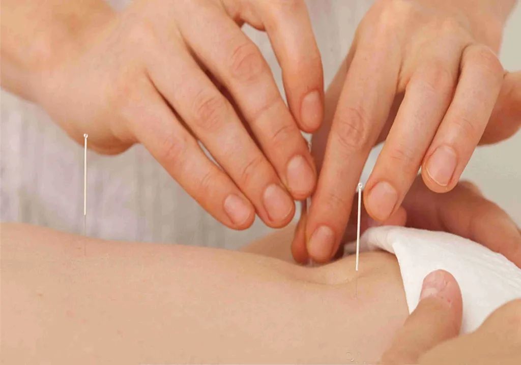 Traditional Chinese Medicine Acupuncture: Harmonizing Yin and Yang, Supporting the Right Qi and Expelling Pathogenic Factors, and Effectively Unblocking Meridians!