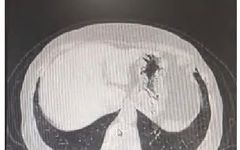 Professor Yan Guizhen's Experience in Treating Pulmonary Nodules Using the Principle of Supporting the Right and Expelling Pathogenic Factors