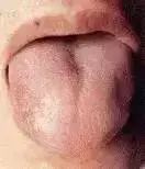 Comprehensive Guide to Tongue Diagnosis: Learn How Your Tongue Reflects Your Health!