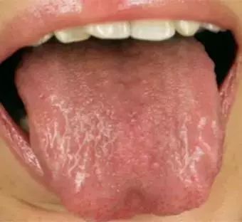 What is Yin Deficiency? Are You Experiencing Yin Deficiency?