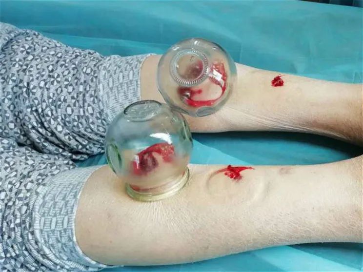 Treatment of Post-Stroke Sequelae with Bloodletting Therapy