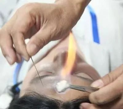 Understanding Fire Needle Therapy in Traditional Chinese Medicine