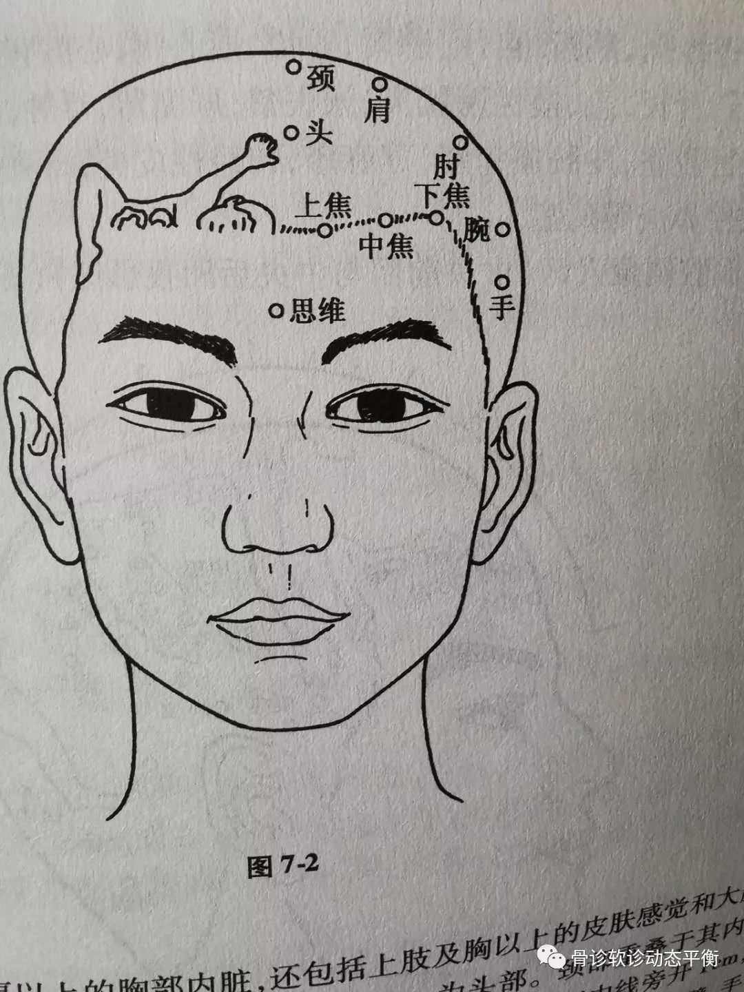 The Scope and Boundaries of the Efficacy of Fine Needling