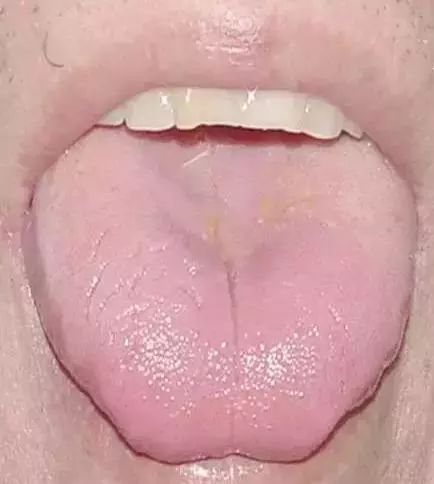 The Most Comprehensive Guide to Tongue Diagnosis! Master It and Become a Tongue Diagnosis Expert