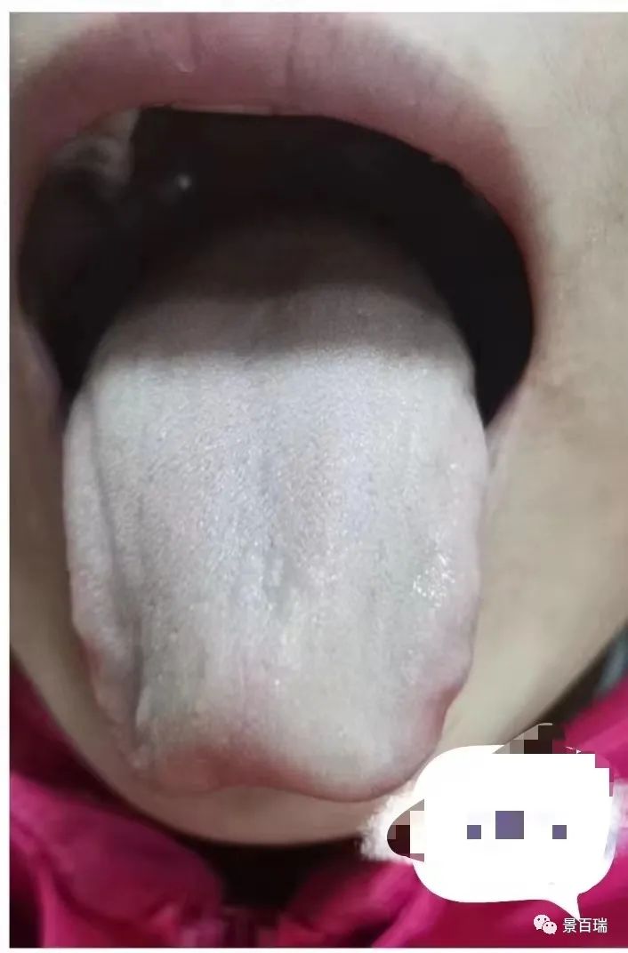 Basic Tongue Diagnosis - Tongue Body and Tongue Coating