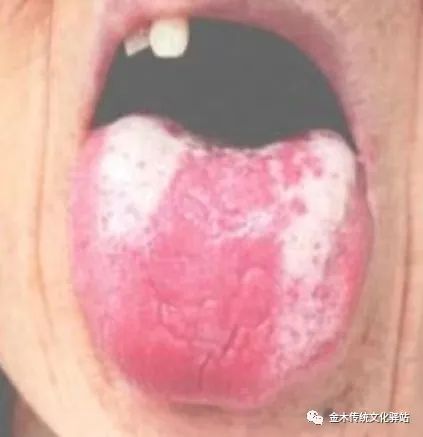 Tongue Diagnosis in Traditional Chinese Medicine: Characteristics of Tongue Coating