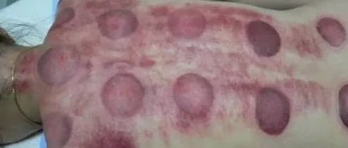 What Do Cupping Marks Indicate After Treatment?