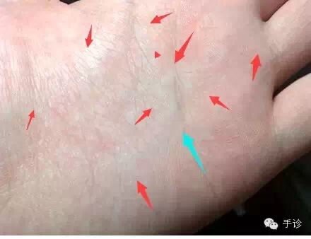 Eight Principles of Hand Diagnosis Based on Color Observation (Must-Collect)