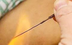 Fire Needle Therapy: A Unique Traditional Chinese Medicine Technique