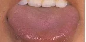 Understanding Tongue Diagnosis in Traditional Chinese Medicine (with Tongue Diagnosis Illustrations)