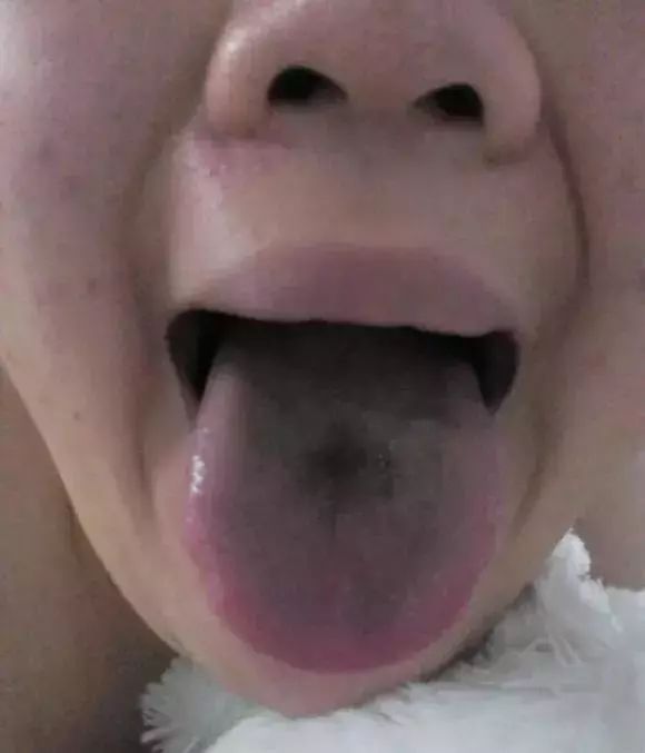 The Most Comprehensive Guide to Tongue Diagnosis! Master It and Become a Tongue Diagnosis Expert