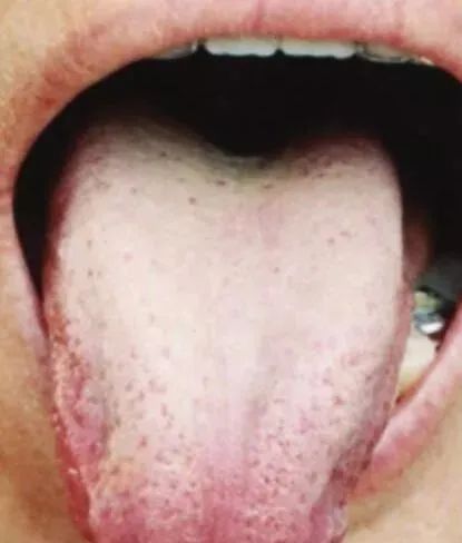 Comprehensive Guide to Tongue Diagnosis and Associated Conditions in TCM