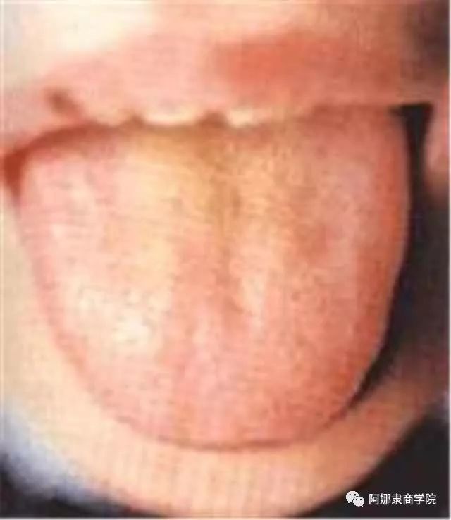 A Comprehensive Guide to 22 High-Definition Tongue Diagnosis Images: Understand Diseases Through Tongue Observation!
