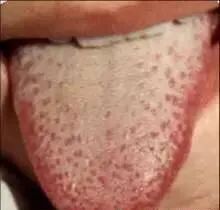 Tongue Diagnosis - Illustrated Guide to Tongue Manifestations