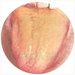 Observing Tongue Coating to Assess Health: A Summary of Classic Tongue Signs in Traditional Chinese Medicine