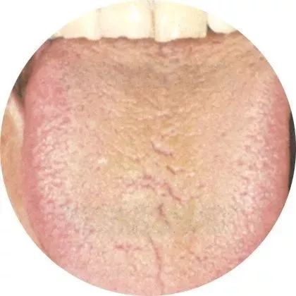 Traditional Chinese Medicine Tongue Diagnosis - Tongue Coating