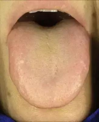 The Most Comprehensive Guide to Tongue Diagnosis! Master It and Become a Tongue Diagnosis Expert