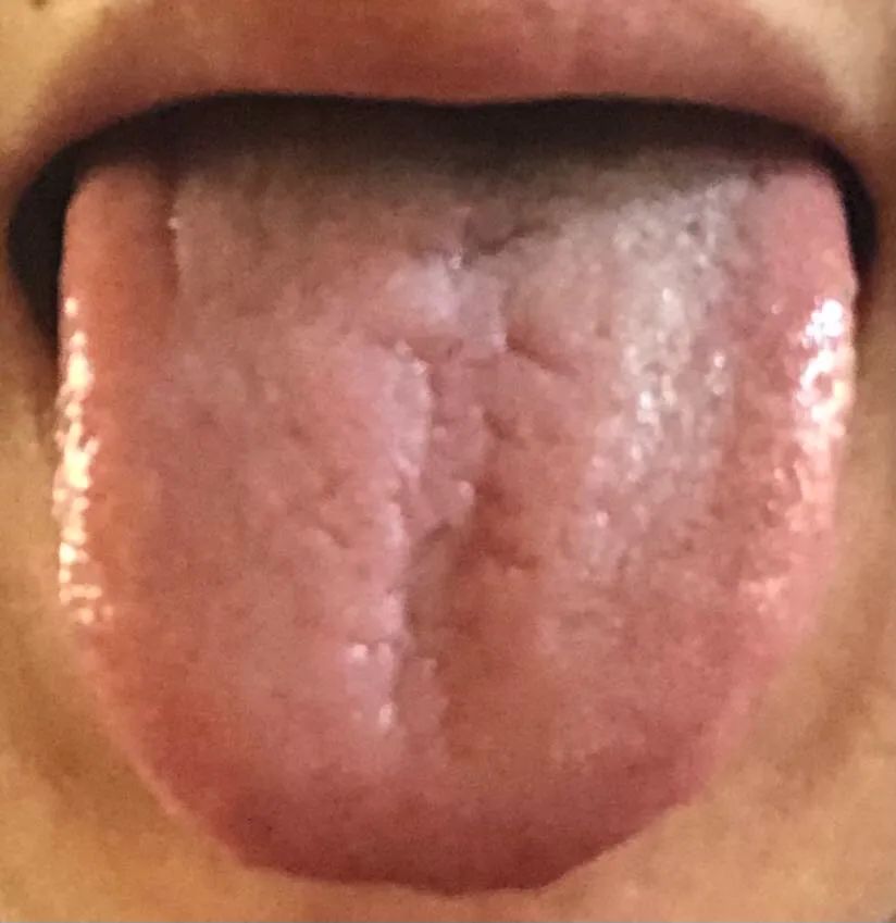 Tongue Diagnosis - Illustrated Guide to Tongue Manifestations
