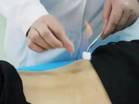 The Powerful Energy of Fire Needles