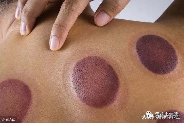 Is Cupping Good? TCM and Western Medicine Warn: This Way of Cupping Could Shorten Your Life, Please Be Aware!