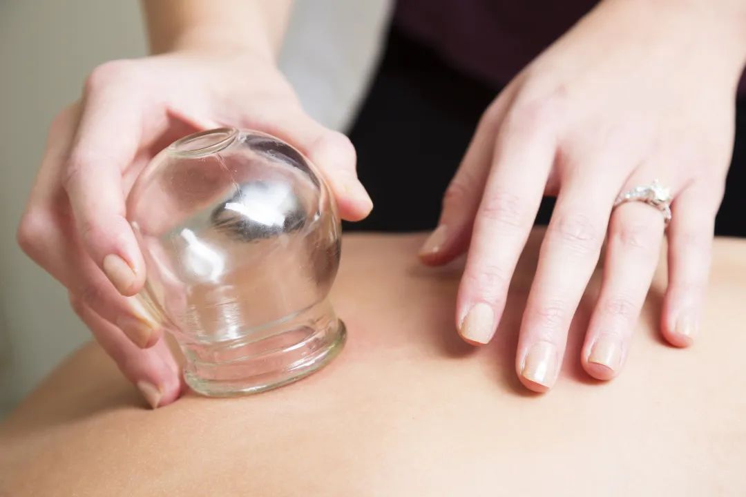 Cupping Therapy: Not Everyone Should Try It! 7 Situations to Avoid