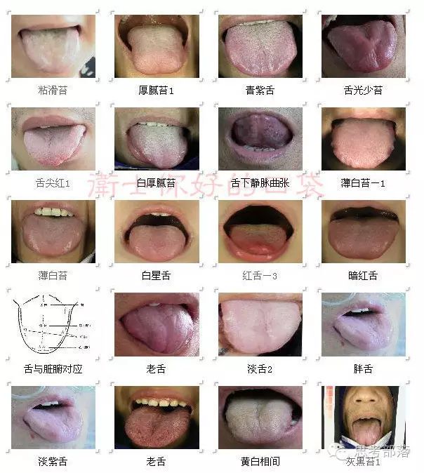 Comprehensive Guide to Tongue Diagnosis (8): 72 Types of Tongue Diagnosis Charts