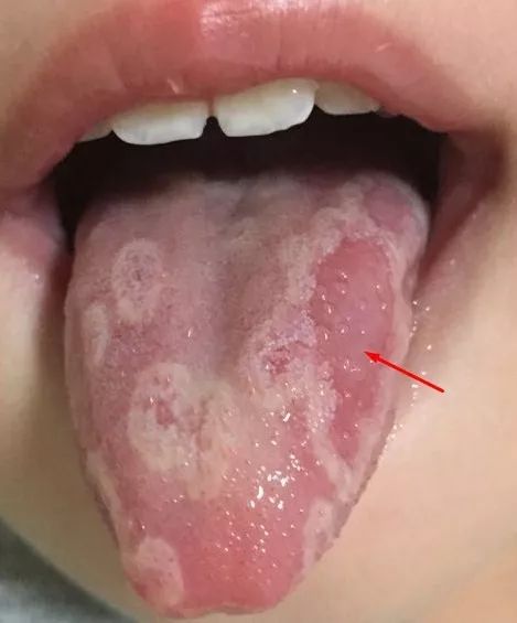 Is a Thick Tongue Coating Always a Sign of Food Accumulation? Can Food Accumulation Be Indiscernible?