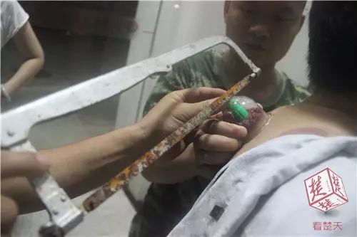 Man Gets Stuck in Cupping Therapy! Firefighters Called for Rescue... Would You Dare to Try It?