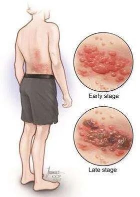 Acupuncture Specialty Treatment - Fire Needle