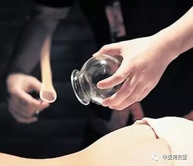 Cupping Therapy for Obesity