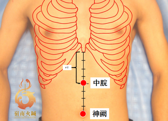 Lingnan Fire Needle Therapy for Post-New Year Food Accumulation