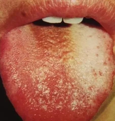 Comprehensive Guide to Tongue Diagnosis and Associated Conditions in TCM