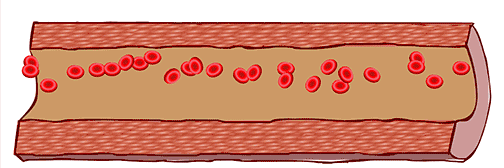 5 Key Indicators to Self-Test for Blood Stasis